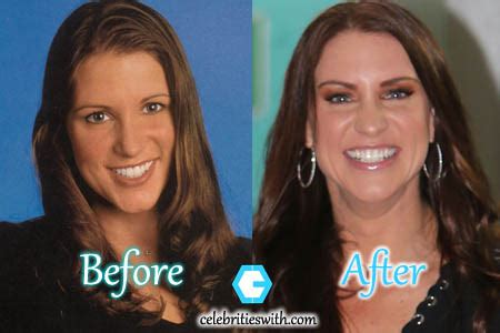 stephanie mcmahon's tits|Stephanie McMahon Plastic Surgery: Before and After Her Boob Job.